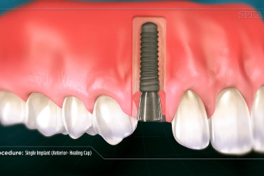 Waarom kiezen voor implantaten?