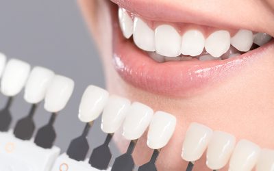 Veel voorkomende tandproblemen die je niet meteen opmerkt