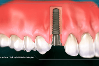 Waarom kiezen voor implantaten?